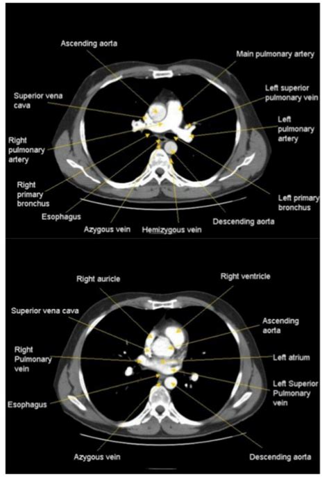 CT Chest Anatomy