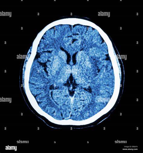 CT Scan image brain