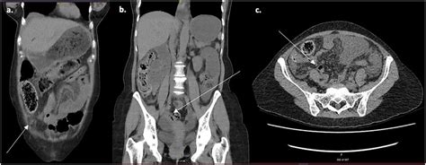 CT scan image non contrast