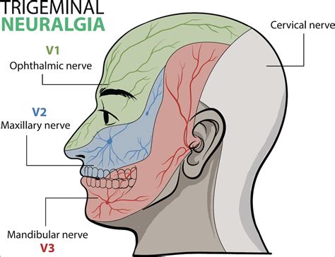 Can trigeminal neuralgia be caused by trauma