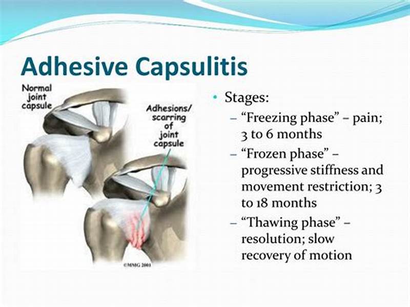 Capsular Pattern Adhesive Capsulitis