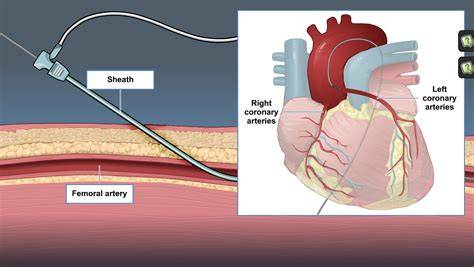 Cardiac Catheterization Procedure