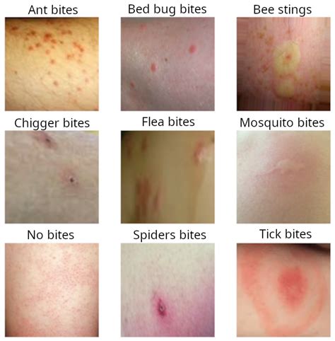 Chart Of Insect Bites