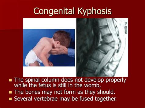 Kifosis Kongenital