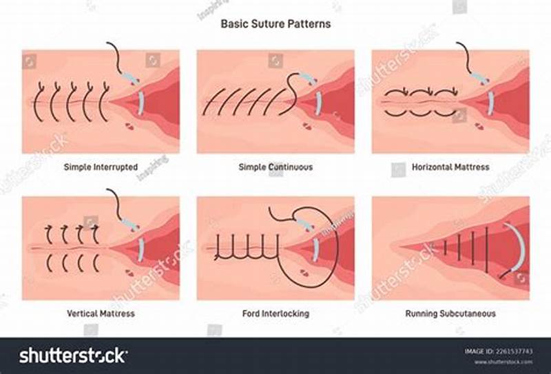 Continuous Suture Pattern