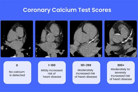 Coronary Calcium Score Chart