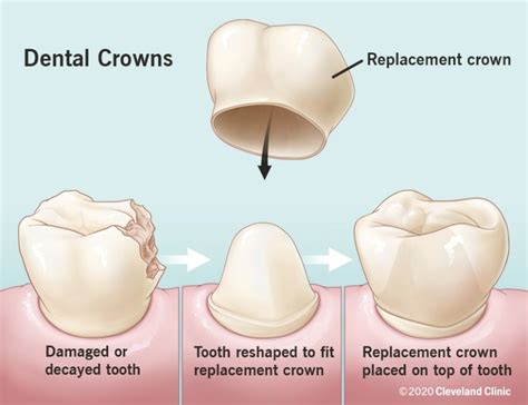 Crown Tooth Procedure