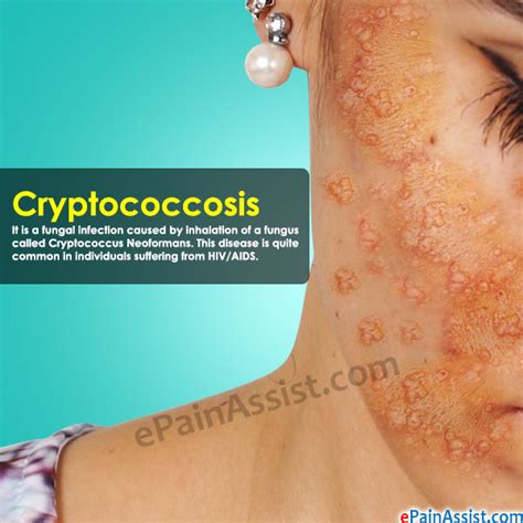 Cryptococcosis diagnosis