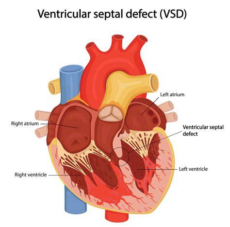 Definisi Ventricular Septal Defect VSD