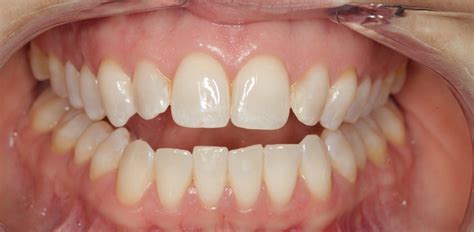Dental Contouring for Fixing an Open Bite