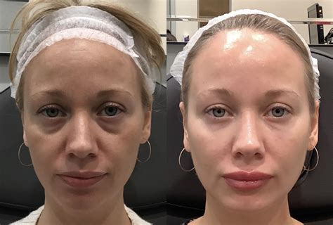 Fillers Before After