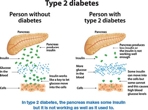 Ilustrasi Diabetes Tipe 2