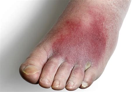 Infections Cellulitis