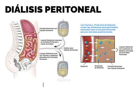 Dialisis Peritoneal