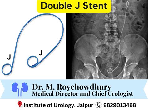 Double J Stent