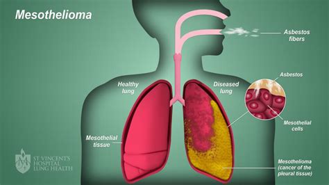 Early Detection Tips for Asbestos-Linked Cancers
