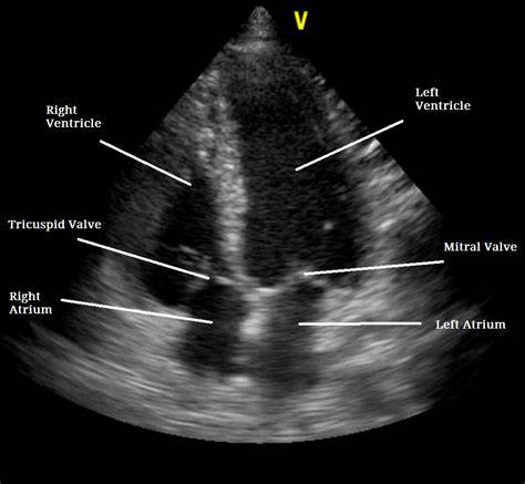 Echocardiogram of Heart