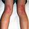 Eczema Behind Knees