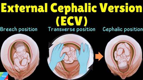 ECV