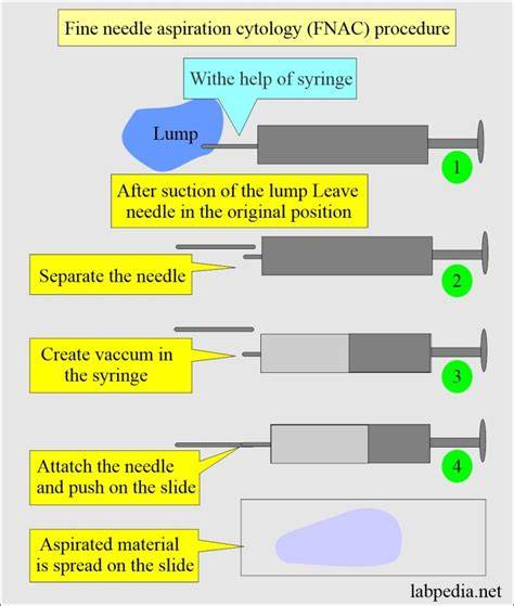 FNAB procedure overview