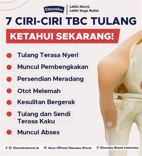 Fakta TBC Tulang
