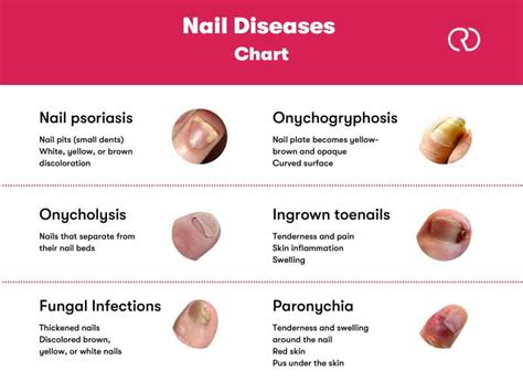 Fingernail Nail Diseases Chart