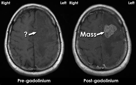 Gadolinium contrast agent