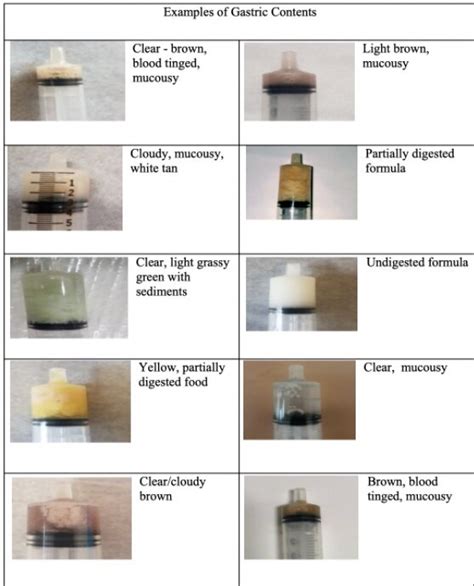 Gastric Aspirate Colour Chart