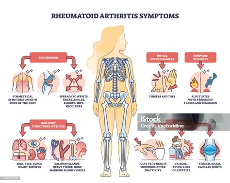 Gejala Rheumatoid Arthritis