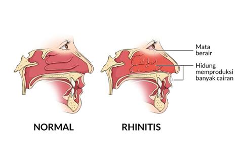 Gejala Rhinitis Alergi