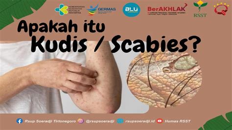 Gejala Scabies