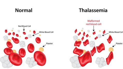 Gejala Thalasemia: Bervariasi Tergantung Jenis dan Tingkat Keparahan