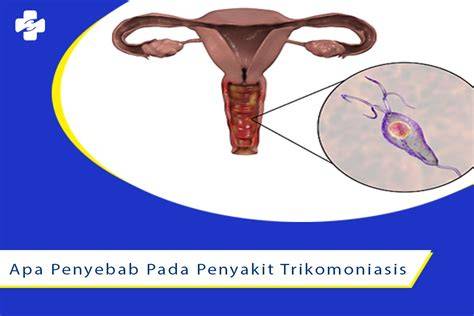 Gejala Trikomoniasis