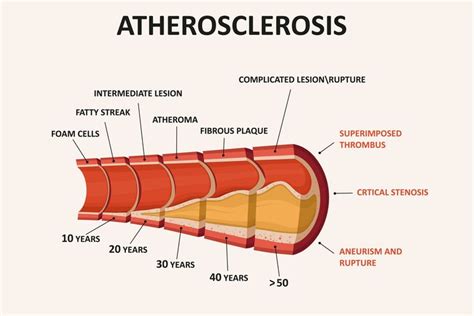 Gejala arteriosklerosis
