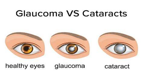 Glaukoma