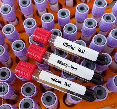 HBeAg blood test concept