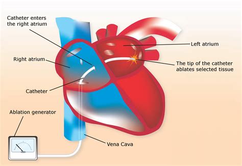 Heart Catheter Ablation