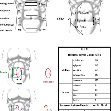 Hernia Size Chart