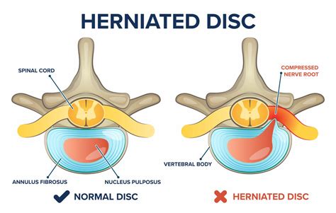 Herniated Disc