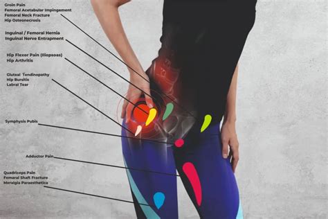 Hip Pain Location Chart