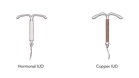Hormonal IUD illustration