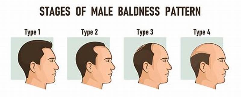 How To Control Male Pattern Baldness