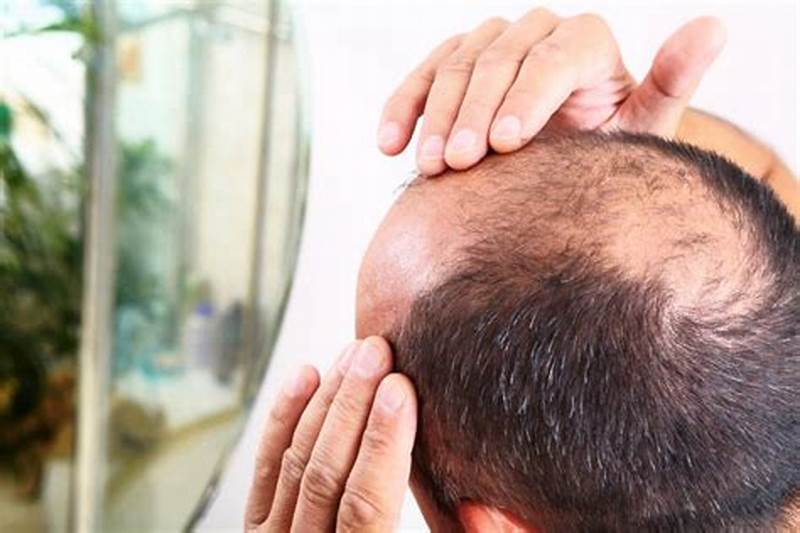 How To Help Male Pattern Baldness
