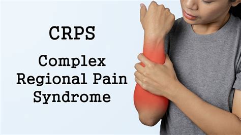 How bad is CRPS