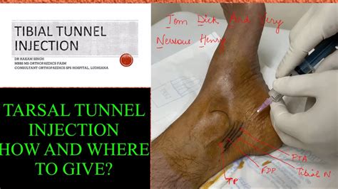 How do you bill a tarsal tunnel injection