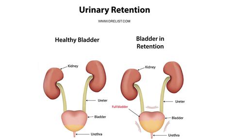 How do you reverse urinary retention