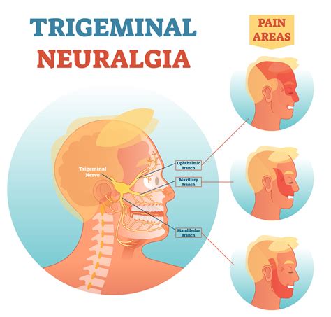 How is trigeminal neuropathy treated
