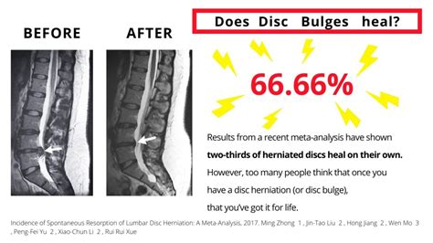 How long does it take to recover from a bulging disc surgery