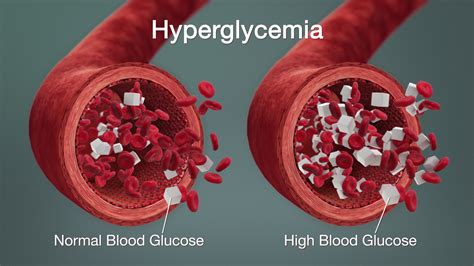 Hiperglikemia (Kadar Glukosa Darah Tinggi)