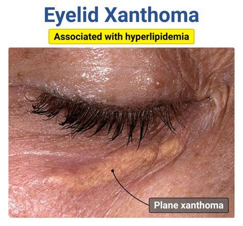 Hyperlipidemia and Xanthoma
